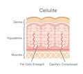 Cellulite`s skin vector illustration Royalty Free Stock Photo