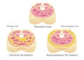 Type of obesity illustration / English