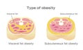 Type of obesity illustration / English Royalty Free Stock Photo