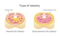 Type of obesity illustration / English