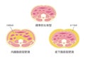 Type of obesity illustration / Japanese