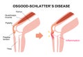 Osgood-schlatter disease vector illustration / English Royalty Free Stock Photo