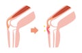 Osgood-schlatter disease vector illustration / no text