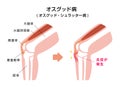 Osgood-schlatter disease vector illustration / Japanese Royalty Free Stock Photo