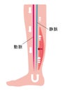 Cause of swelling, edema of the legs. / Japanese