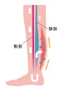 Cause of swelling, edema of the legs. / Japanese