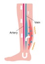 Cause of swelling, edema of the legs. / English