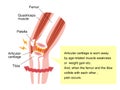 Mechanism and causes of knee joint pain / English Royalty Free Stock Photo