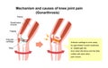 Mechanism and causes of knee joint pain / English