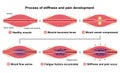 Process of muscle`s stiffness and pain / English