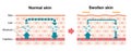 Comparison illustration of normal skin and swollen skin / English