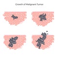 Vector isolated illustration of malignant tumor