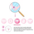 Medical infographic Adenomyosis that could be causing women period pain Royalty Free Stock Photo