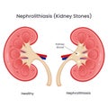Vector illustration of a healthy kidney compared to a kidney with kidney stones