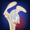 rupture of the clavicular cavity. Rendering of a collarbone on a blue neon background