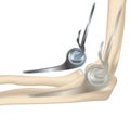 Endoprosthetics of the elbow joint, humeral head.