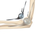 Endoprosthetics of the elbow joint, humeral head. Royalty Free Stock Photo