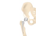 Endoprosthetics, hip joint prosthesis.