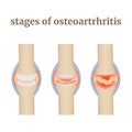 Stages of osteoarthrosis, destruction of joints and cartilage disease. Royalty Free Stock Photo