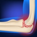 Arthrosis of the elbow joint. Illustration of hand bones on a neon blue background Royalty Free Stock Photo