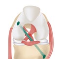 Cruciate ligament rupture. Knee arthroscopy. Drawer syndrome Royalty Free Stock Photo