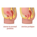 Medical diagram with uterine prolapse. Before and after. Royalty Free Stock Photo