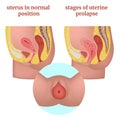 Stages of uterine prolapse. Female reproductive organs diagram and disease infographic. Royalty Free Stock Photo