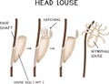 Structure of head louse egg (nit) attached to a hair and louse hatching Royalty Free Stock Photo