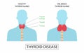 illustration of biology and medical, Thyroid disorders can range from a small Royalty Free Stock Photo