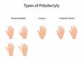 illustration of biology and medical, Types of polydactyly, Symptoms of Polydactyly Royalty Free Stock Photo