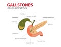Diagram illustrating gallstones and cholecystitis affecting the gallbladder and pancreas anatomy Royalty Free Stock Photo