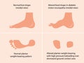 Altered shape of the foot caused by diabetic motor neuropathy.