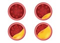 Atherosclerosis stage in human blood / cholesterol vector