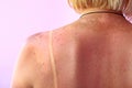Traces of sunburn on the back of a woman. Female body Royalty Free Stock Photo