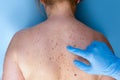 Problem skin with birthmarks. Dermatologist examining the patient. Closeup of freckles on the back of a woman