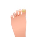 Problem skin and nails of foot