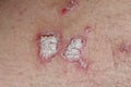 Psoriasis is an autoimmune disease that affects the skin causing red, scaly skin inflammation.