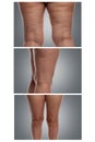 Problematic female legs with excess weight, cellulite and veins. Gray background. Collage. Vertical