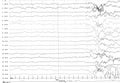 Problems in the electrical activity of the brain.Abnormal EEG.