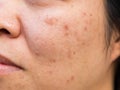 Problems facial skin is acne and blemishes