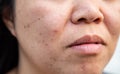 Problems facial skin is acne and blemishes