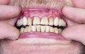 Problems with the teeth and gums Royalty Free Stock Photo