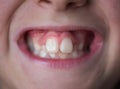 Problems with the teeth of a young boy. Not the correct bite Royalty Free Stock Photo