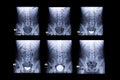 procedure of Intravenous pyelogram or I.V.P.