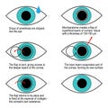 Procedure of laser correction of vision step by step. Infographics Royalty Free Stock Photo