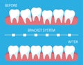 The process of correction of teeth with orthopedic braces.