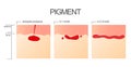 The process of engraftment of the pigment after the salon procedure of permanent make-up. Royalty Free Stock Photo