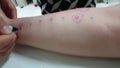 Process of food allergy skin prick test with rash sensitive reaction