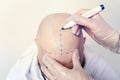process of hair transplantation on the head. treatment of baldness. a nurse draws stripes on the bald skull of a young Royalty Free Stock Photo