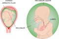 The process of Meconium aspiration syndrome MAS also known as neonatal aspiration of meconium. Fetus in womb. Mecinium